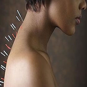 Acupuntura
